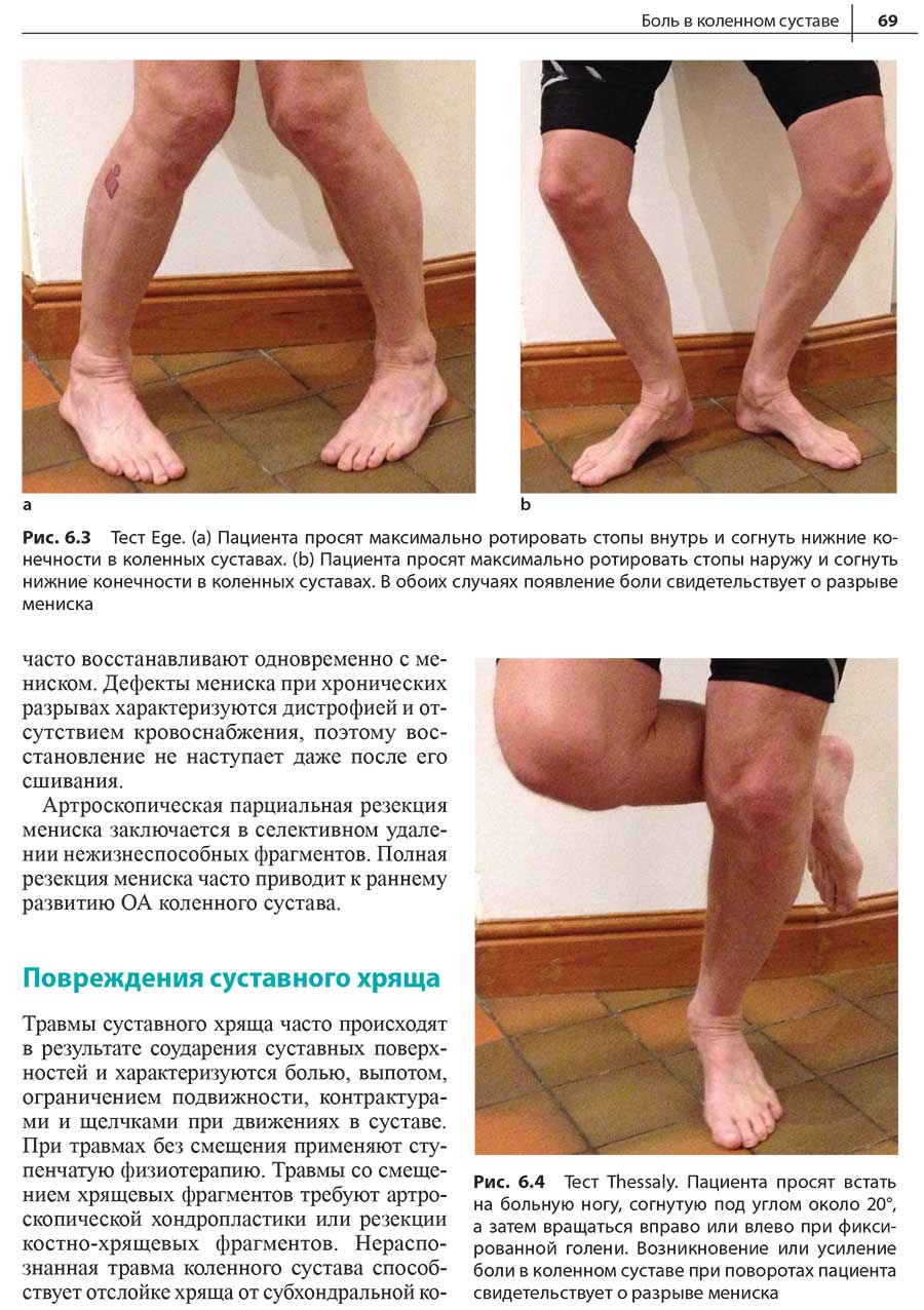 Рис. 6.4 Тест Thessaly. Пациента просят встать на больную ногу