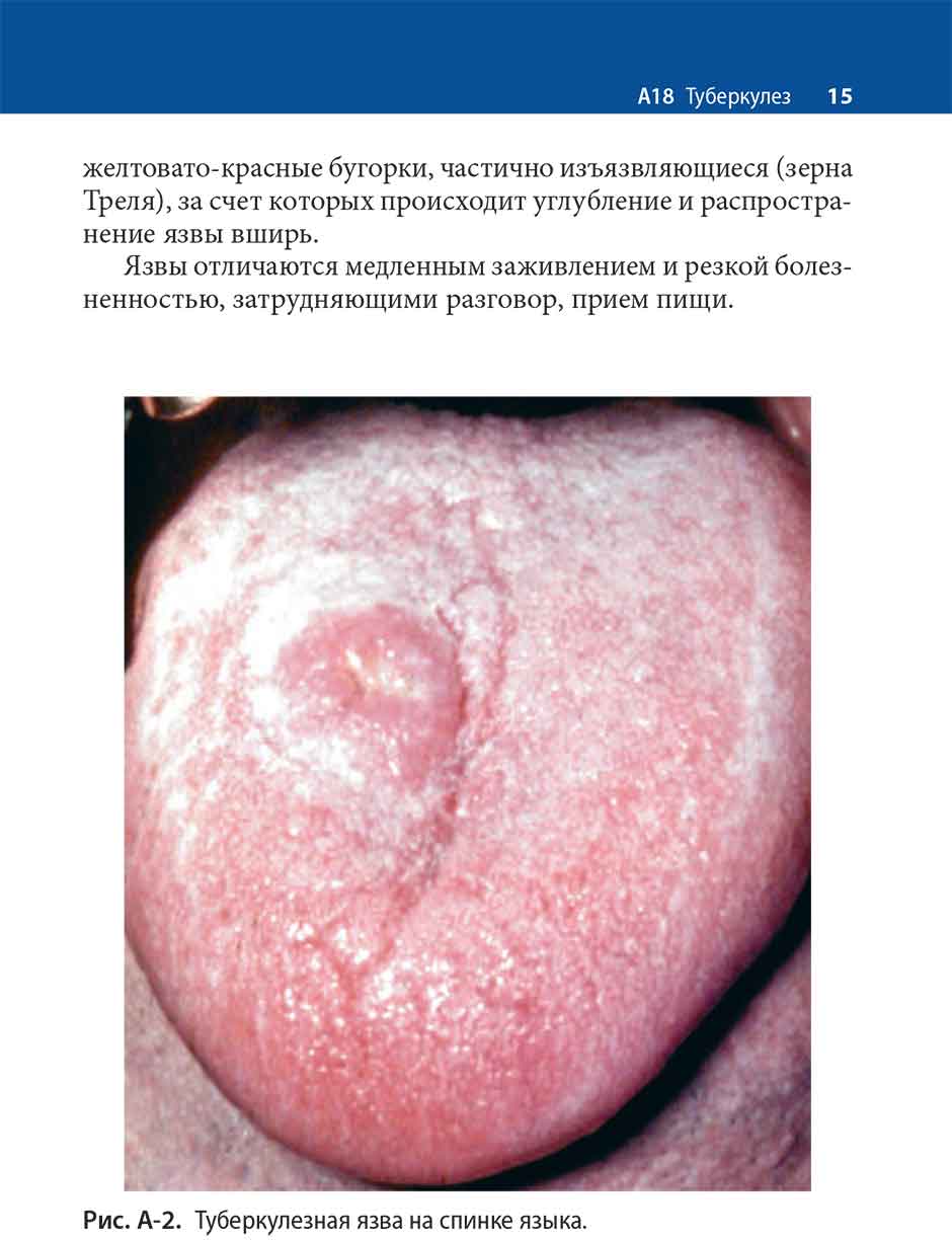 Рис. А-2. Туберкулезная язва на спинке языка.