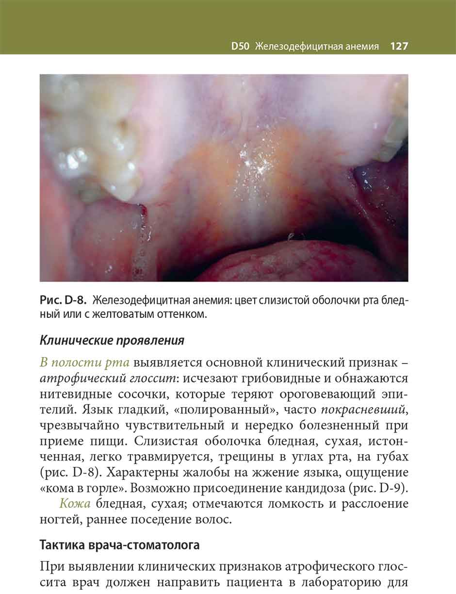 Рис. D-8. Железодефицитная анемия
