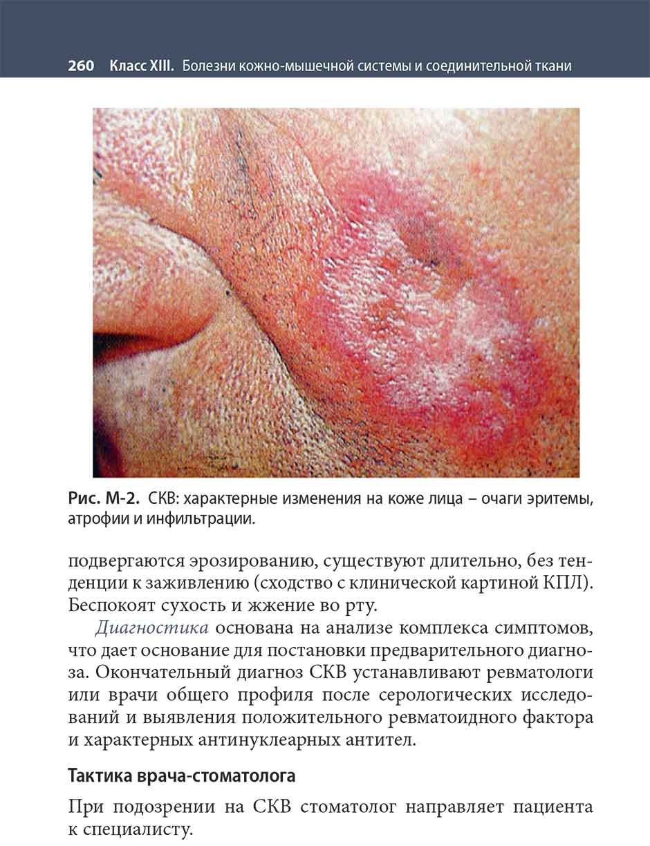 Рис. М-2. СКВ: характерные изменения на коже лица - очаги эритемы, атрофии и инфильтрации.