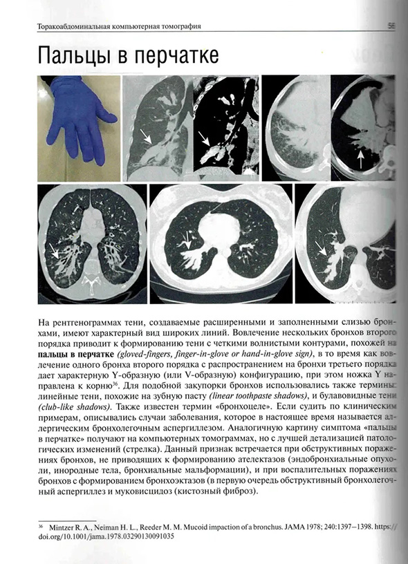 На рентгенограммах тени, создаваемые расширенными и заполненными слизью На рентгенограммах тени, создаваемые расширенными и заполненными слизью