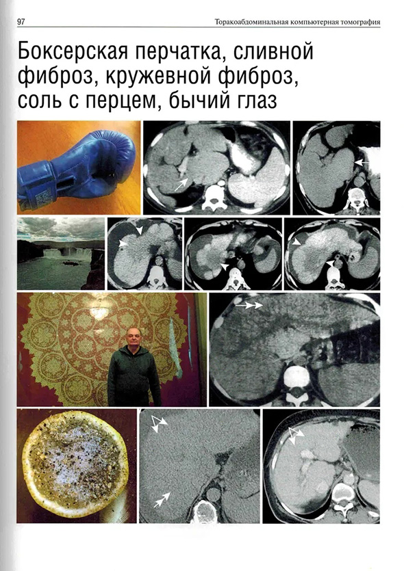 Боксерская перчатка, сливной фиброз, кружевной фиброз, соль с перцем, бычий глаз Боксерская перчатка, сливной фиброз, кружевной фиброз, соль с перцем, бычий глаз