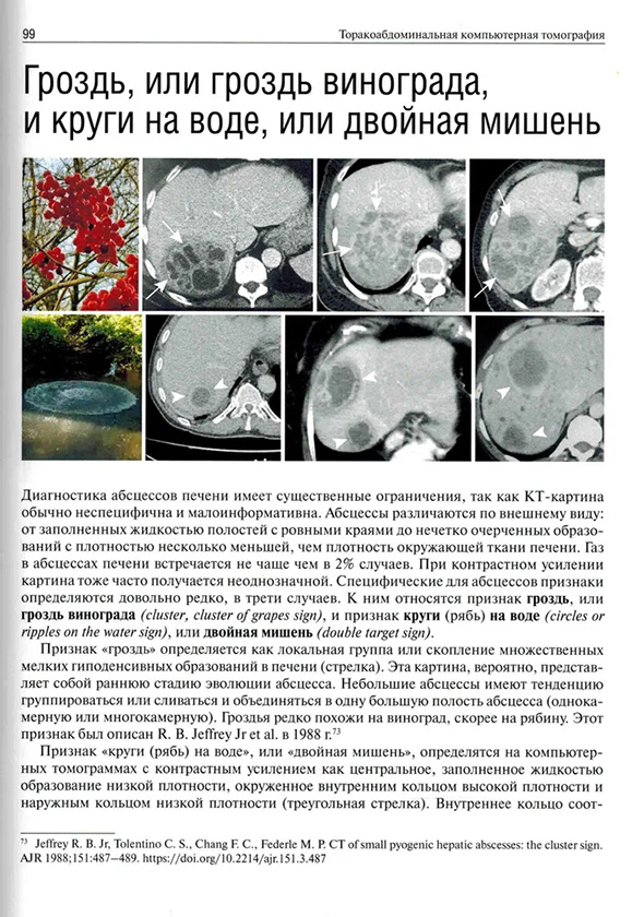 Диагностика абсцессов печени имеет существенные ограничения, так как КТ-картина Диагностика абсцессов печени имеет существенные ограничения, так как КТ-картина