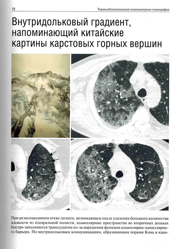 При реэкспансивном отеке легкого, возникающем после удаления большого количества жидкости из плевральной полости, альвеолярные пространства во вторичных дольках При реэкспансивном отеке легкого, возникающем после удаления большого количества жидкости из плевральной полости, альвеолярные пространства во вторичных дольках