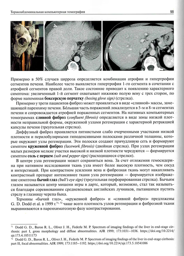 Примерно в 50% случаев цирроза определяется комбинация атрофии и гипертрофии Примерно в 50% случаев цирроза определяется комбинация атрофии и гипертрофии
