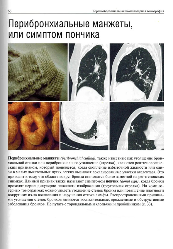 Перибронхиальные манжеты, также известные как утолщение бронхиальной стенки Перибронхиальные манжеты, также известные как утолщение бронхиальной стенки
