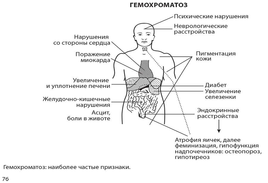 Гемохроматоз