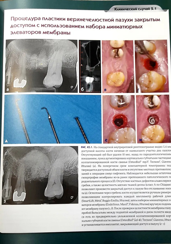 Пример страницы из книги "Регенеративные технологии в стоматологии. Научно-практическое руководство" - Барон Антонио Пример страницы из книги "Регенеративные технологии в стоматологии. Научно-практическое руководство" - Барон Антонио