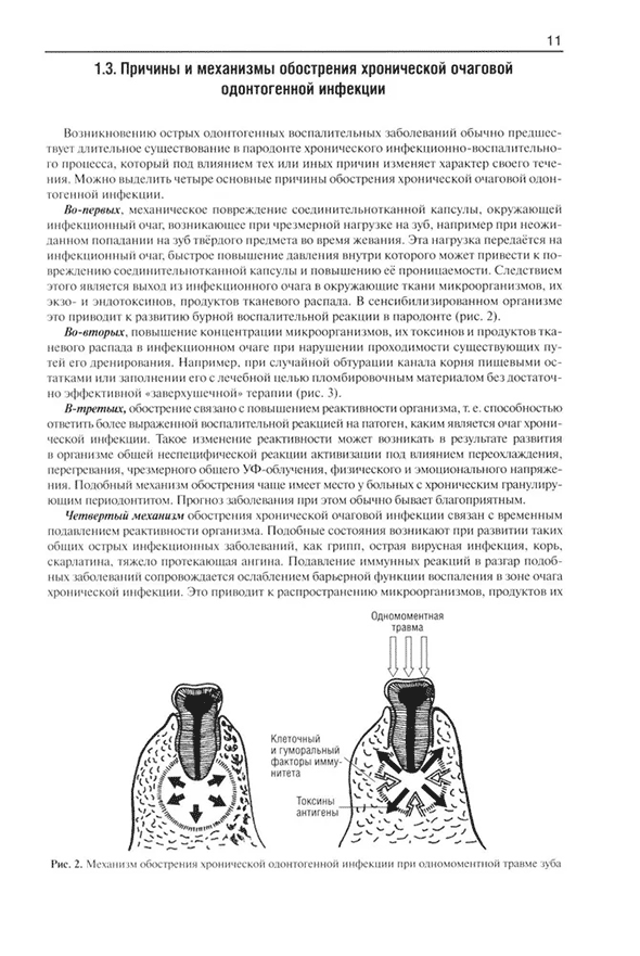 Причины и механизмы обострения хронической очаговой одонтогенной инфекции