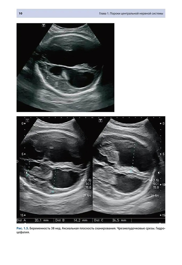 Рис. 1.5. Беременность 38 нед. Аксиальная плоскость сканирования. Чрезжелудочковые срезы. Гидроцефалия.