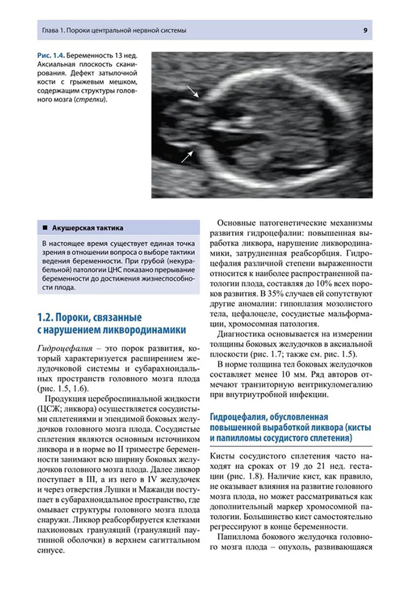 Пороки центральной нервной системы