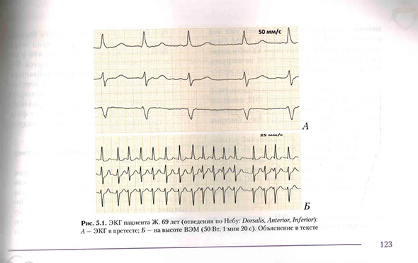 Пример страницы из книги  "Пробы с физической нагрузкой в аритмологии" - Трешкур Т. В.