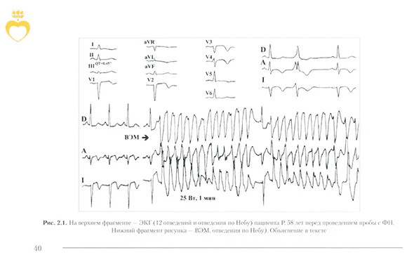 Пример страницы из книги  "Пробы с физической нагрузкой в аритмологии" - Трешкур Т. В.