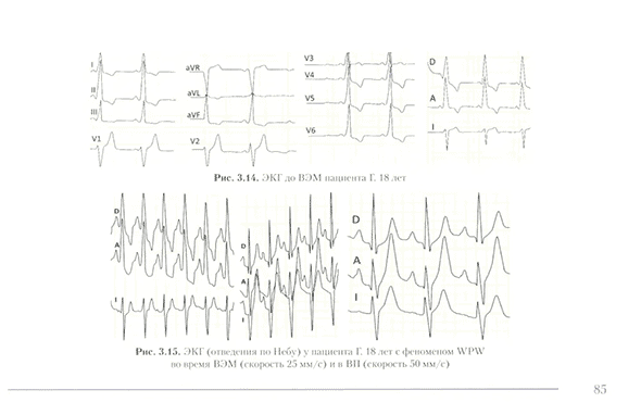 Пример страницы из книги  "Пробы с физической нагрузкой в аритмологии" - Трешкур Т. В.