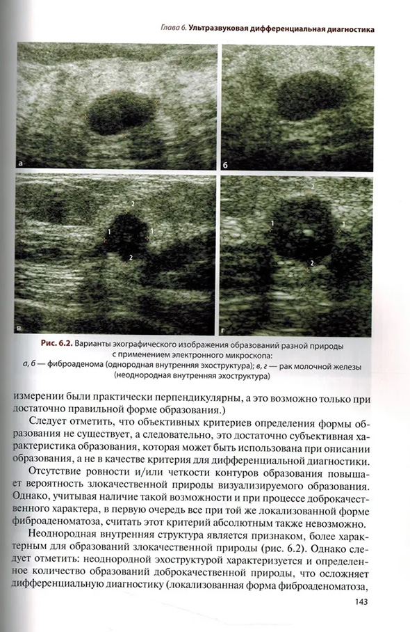 Фиброаденома