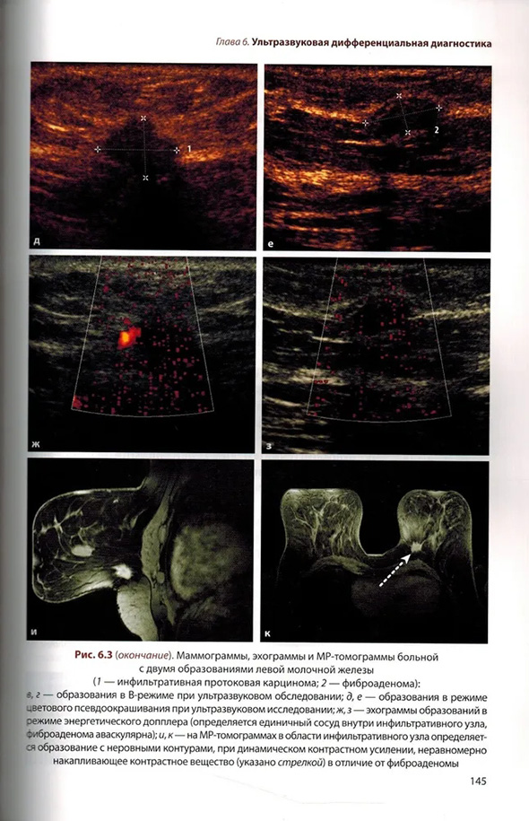 Маммограммы, эхограммы и MP-томограммы больной с двумя образованиями левой молочной железы