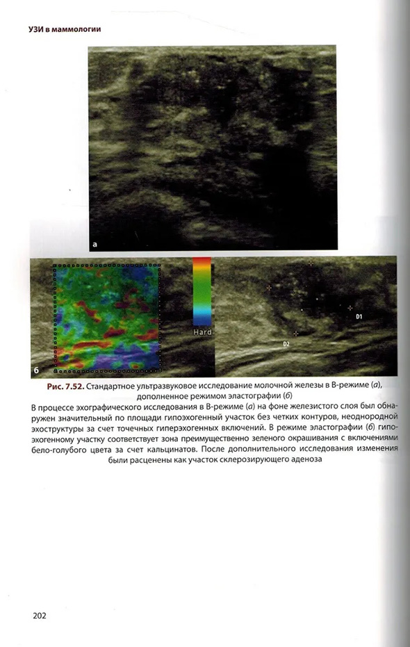 Стандартное ультразвуковое исследование молочной железы в В-режиме 