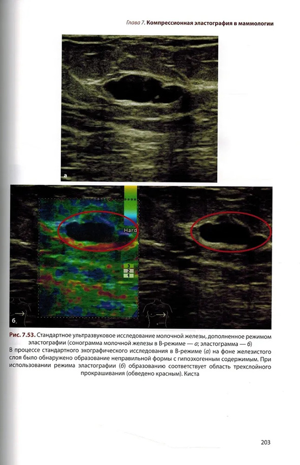 Стандартное ультразвуковое исследование молочной железы, дополненное режимом