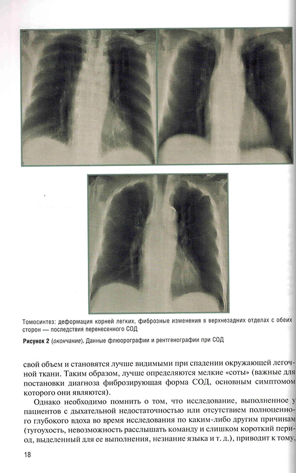 Томосинтез: деформация корней легких, фиброзные изменения