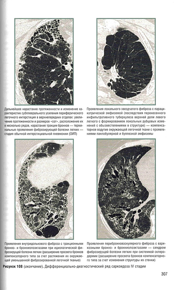 Дифференциально-диагностический ряд саркоидоза