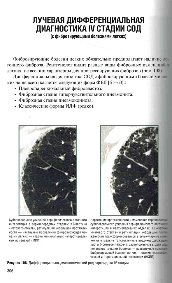 Лучевая дифференциальная диагностика IV стадии СОД
