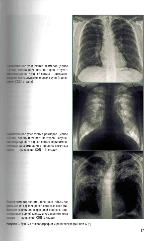Пример страницы из книги "Саркоидоз. Роль ренгенолога в мультидисциплинарном консилиуме" - Сперанская А. А.