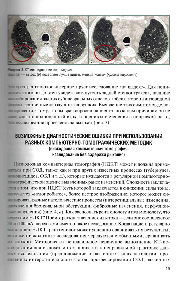 КТ-исследование «на выдохе»