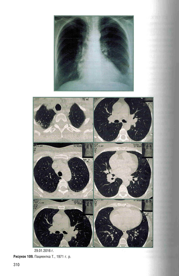 Пример страницы из книги "Саркоидоз. Роль ренгенолога в мультидисциплинарном консилиуме" - Сперанская А. А.