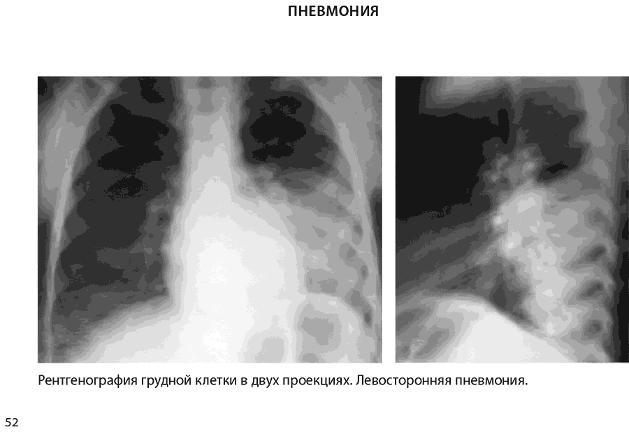 Рентгенография грудной клетки в двух проекциях. Левосторонняя пневмония