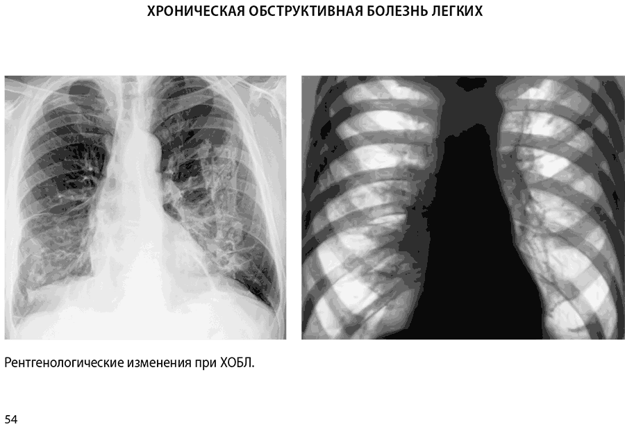 Рентгенологические изменения при ХОБЛ.