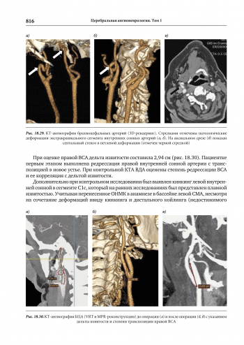 Пример страницы из книги "Церебральная ангионеврология" - Скоромец А. А., Амелин А. В., Баранцевич Е. Р., Вознюк И. А.