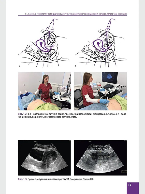 Пример визуализации матки при ТАУЗИ Пример визуализации матки при ТАУЗИ