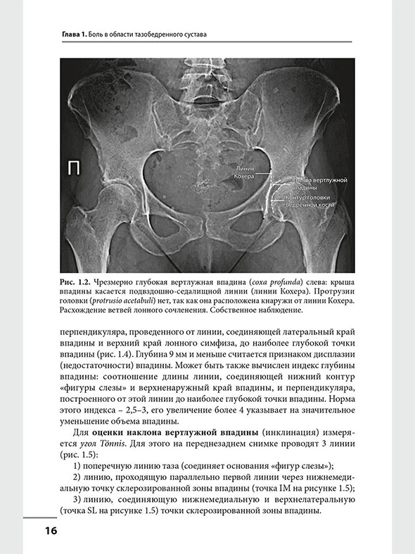 Чрезмерна глубокая вертлужная впадина Чрезмерна глубокая вертлужная впадина
