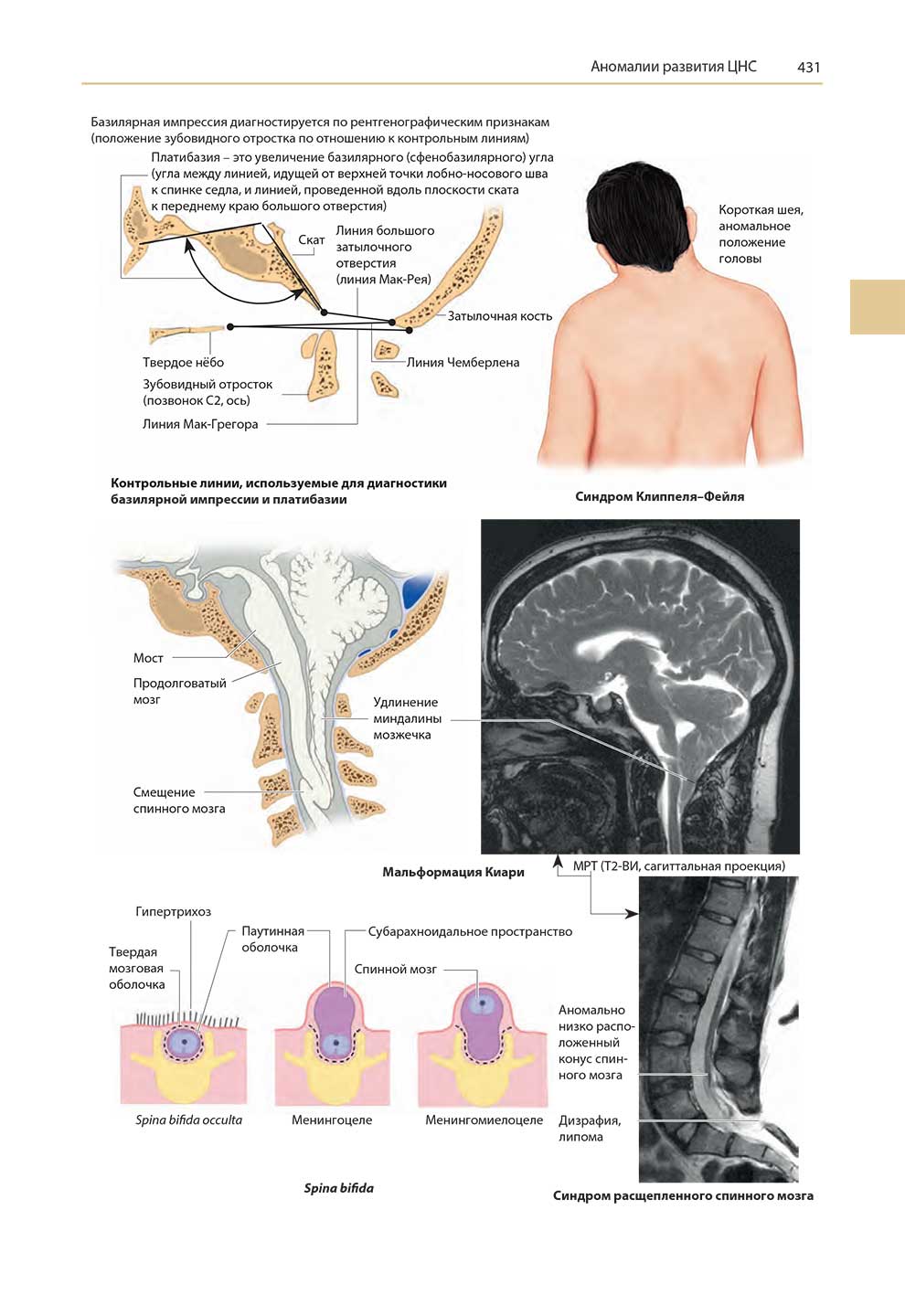 Синдром расщепленного спинного мозга