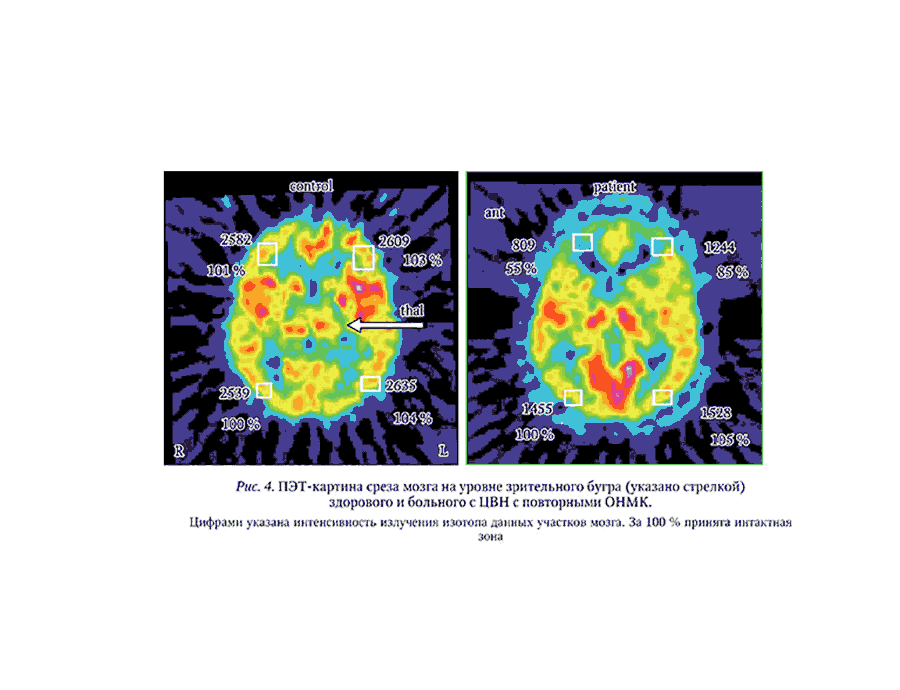Рис. 4. ПЭТ-картина среза мозга на уровне зрительного бугра (указано стрелкой)