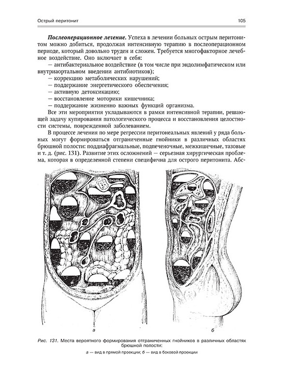 Места формирования отграниченных гнойников