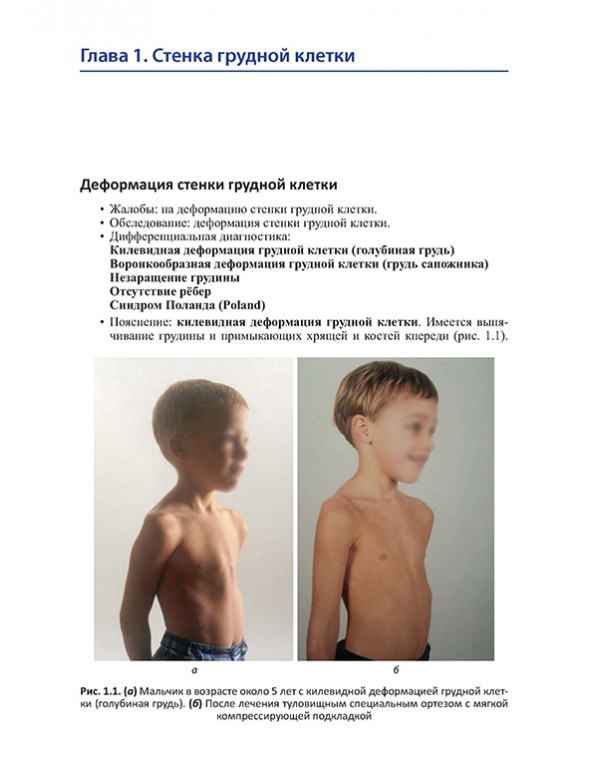 Мальчик в возрасте около 5 лет с килевидной деформацией грудной клетки