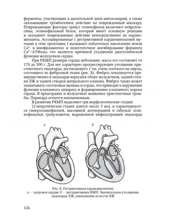 Рис. 8. Рестриктивная кардиомиопатия