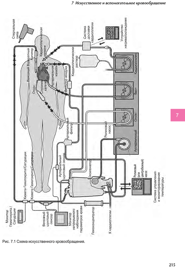 Схема искусственного кровообращения