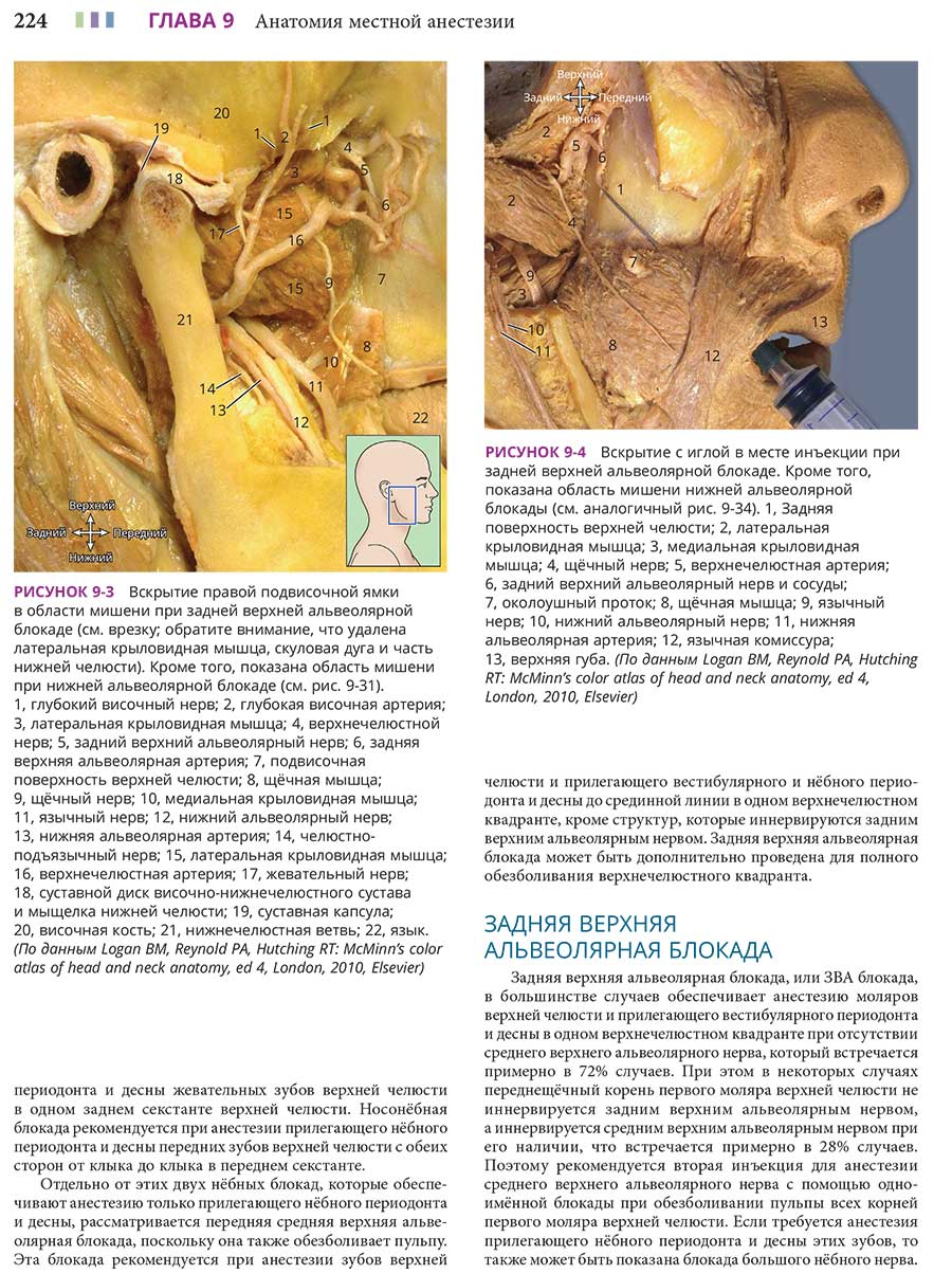 РИСУНОК 9-4 Вскрытие с иглой в месте инъекции при задней верхней альвеолярной блокаде