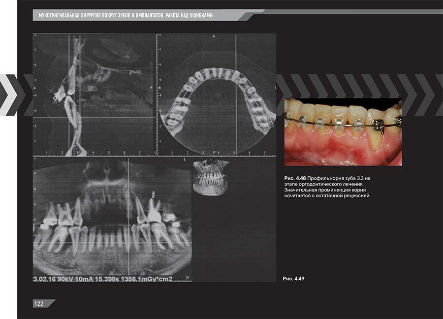 Рис. 4.48 Профиль корня зуба 3.3 на этапе ортодонтического лечения. 