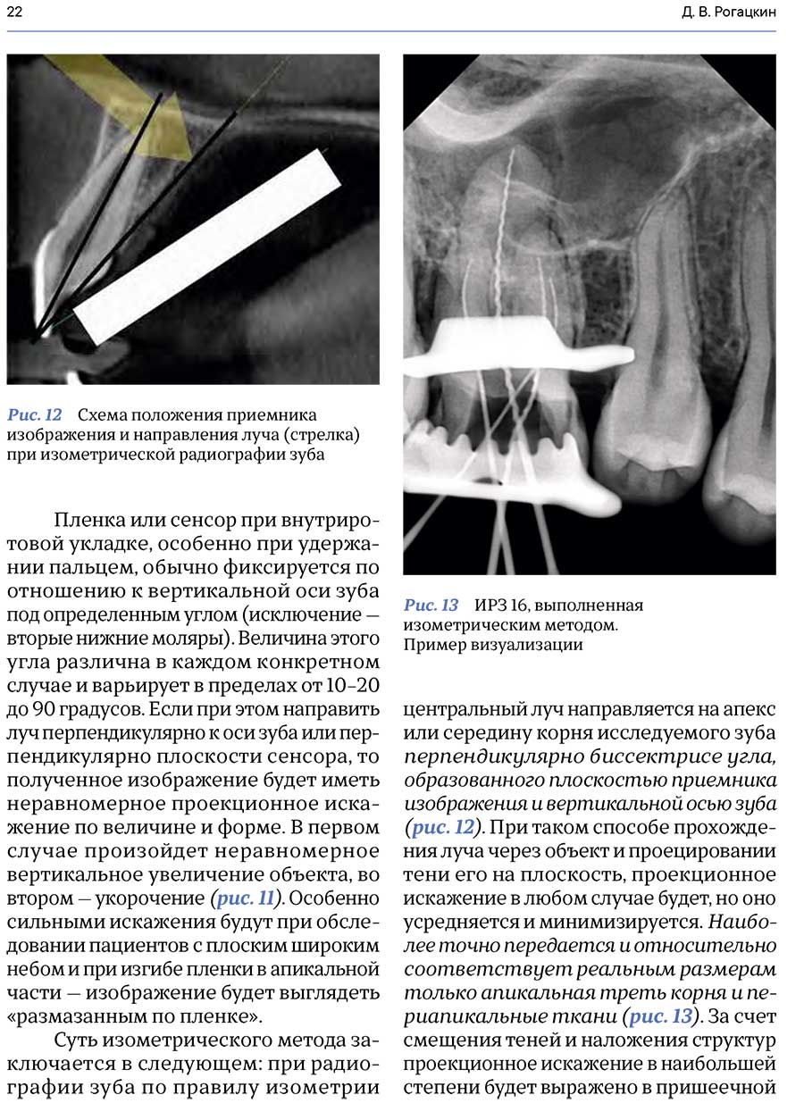 Рис. 12 Схема положения приемника изображения и направления луча (стрелка) при изометрической радиографии зуба
