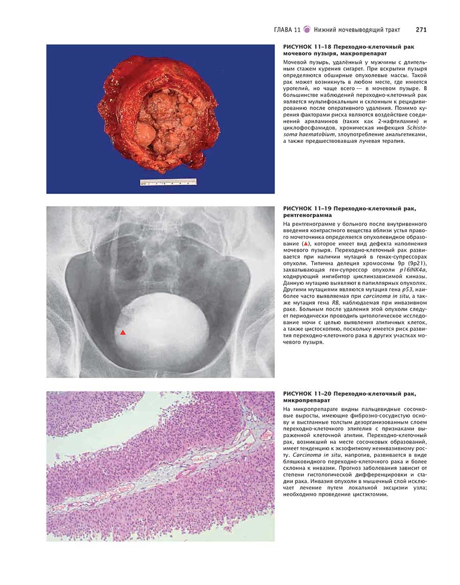 РИСУНОК 11-19 Переходно-клеточный рак, рентгенограмма
