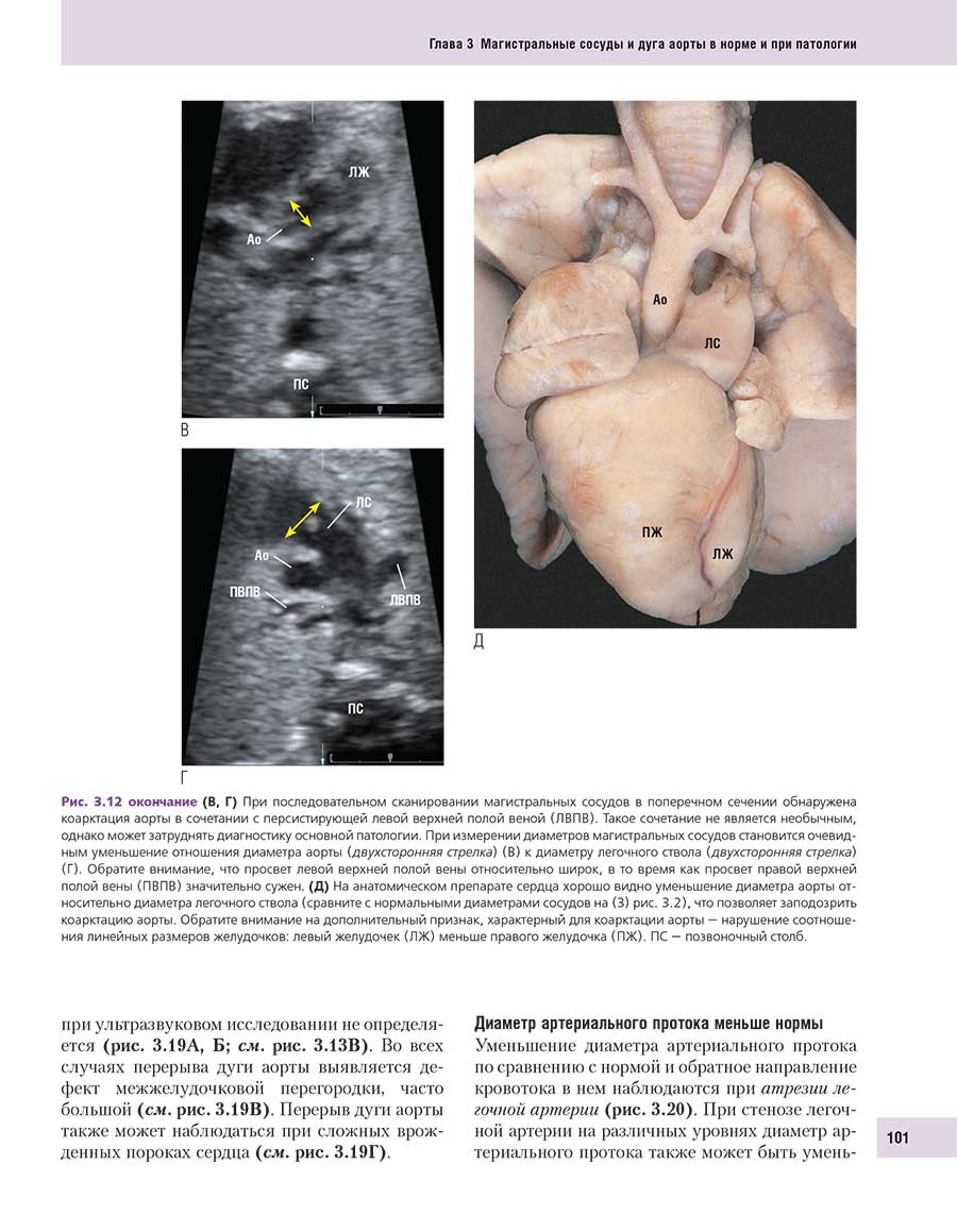 Рис. 3.12 При последовательном сканировании магистральных сосудов в поперечном сечении обнаружена коарктация аорты в сочетании с персистирующей левой верхней полой веной (ЛВПВ). Такое сочетание не является необычным.