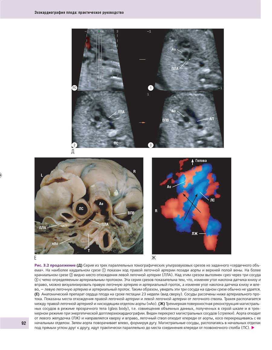 Рис. 3.2 продолжение (Д) Серия из трех параллельных томографических ультразвуковых срезов