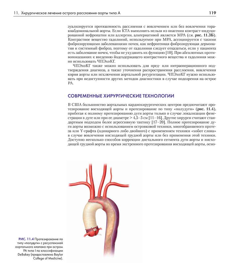 РИС. 11.4 Протезирование по типу «полудуги» с ресуспензией аортального клапана при остром