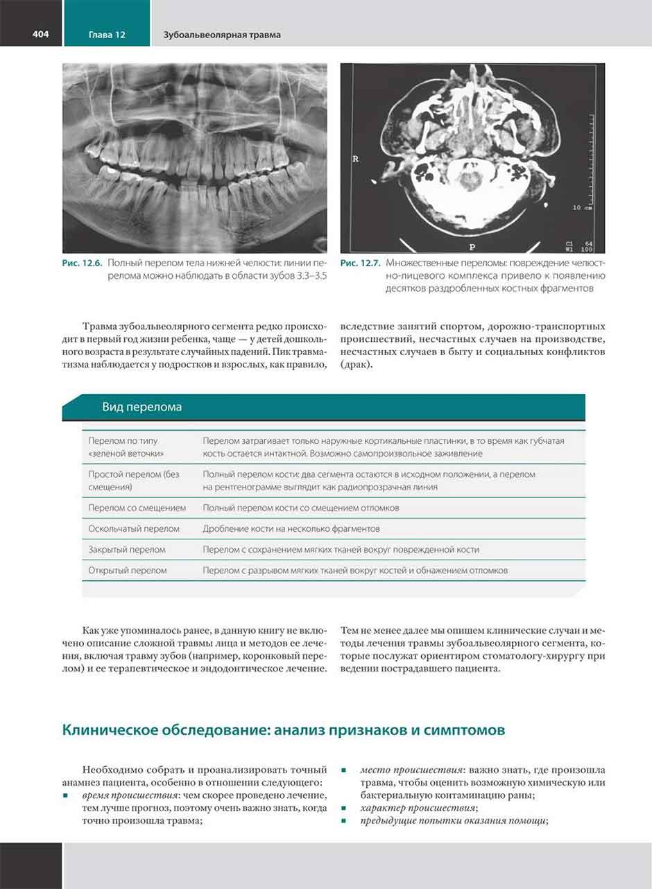 Рис. 12.6. Полный перелом тела нижней челюсти: линии