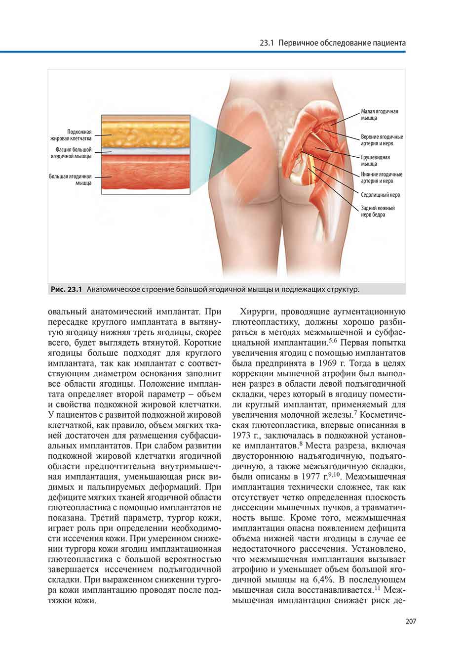 Рис. 23.1 Анатомическое строение большой ягодичной мышцы и подлежащих структур.