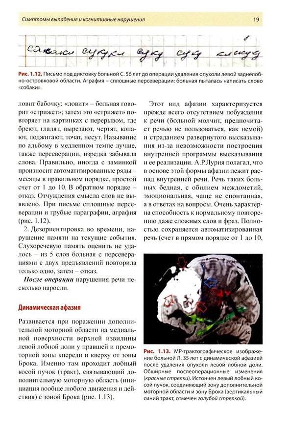 Рис. 1.13. МР-трактографическое изображение больной Л. 35 лет с динамической афазией после удаления опухоли левой лобной доли.
