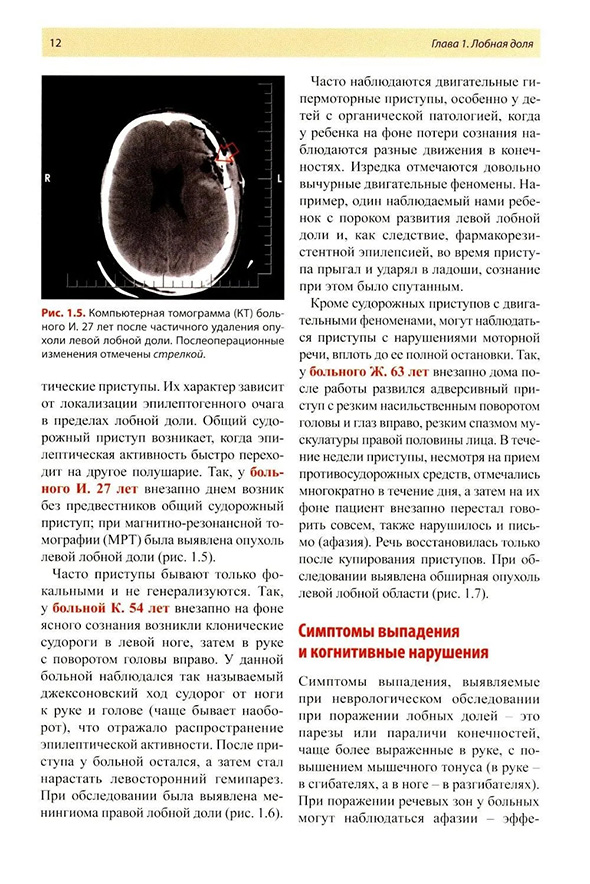 Рис. 1.5. Компьютерная томограмма (КТ) больного И. 27 лет после частичного удаления опу холи левой лобной доли. Послеоперационные изменения отмечены стрелкой.